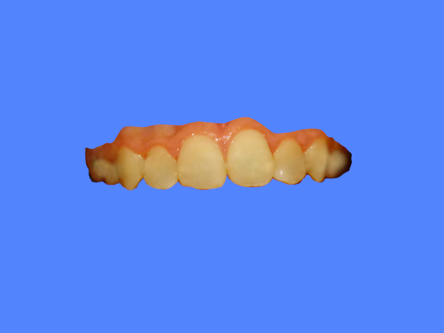 A patient with straight front teeth